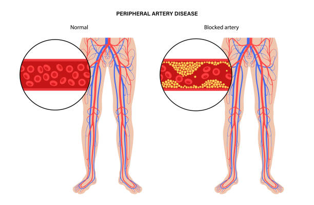 Peripheral Arterial Disease